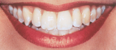 Swansea Teeth Whitening