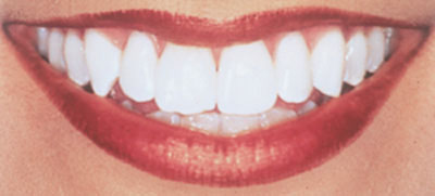 Swansea Teeth Whitening