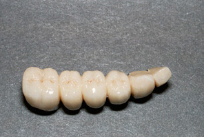 Swansea Dental Implant 2
