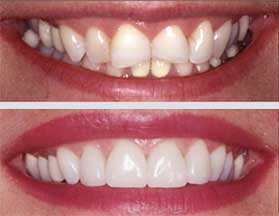 Swansea Porcelain Veneers