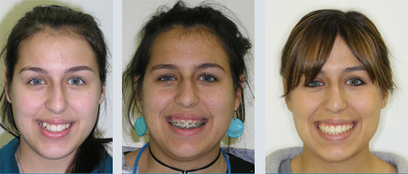 Patient Testimonials - Braces