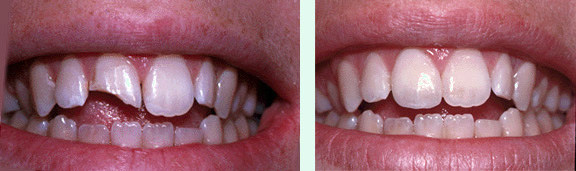 Swansea Porcelain Veneers