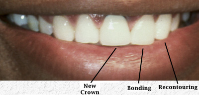 Swansea Porcelain Veneers