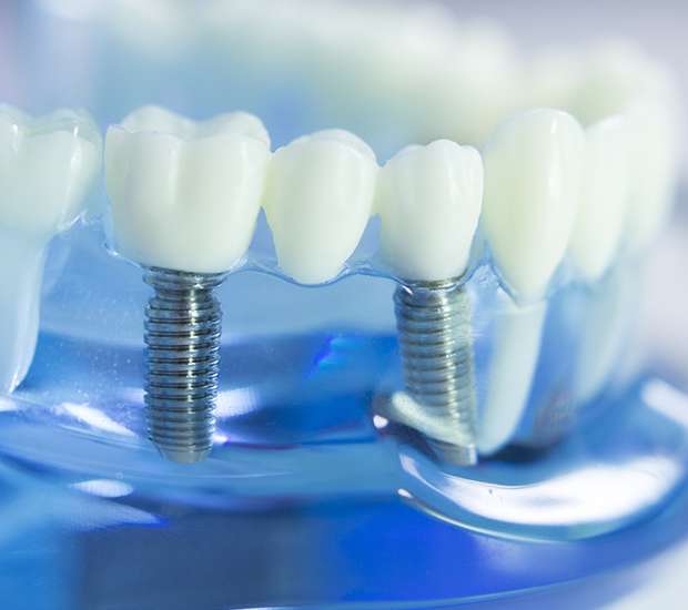 Swansea Dental Implants